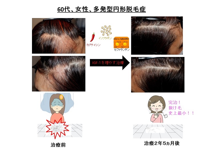 円形脱毛症　病院